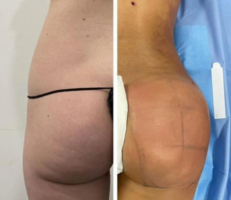 Before and after side-by-side images of a person's buttocks. The left shows the natural state, and the right shows changes post-surgery or procedure.