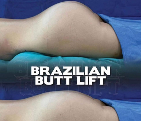 Before and after results of a Brazilian Butt Lift showing enhanced buttock volume and contour.