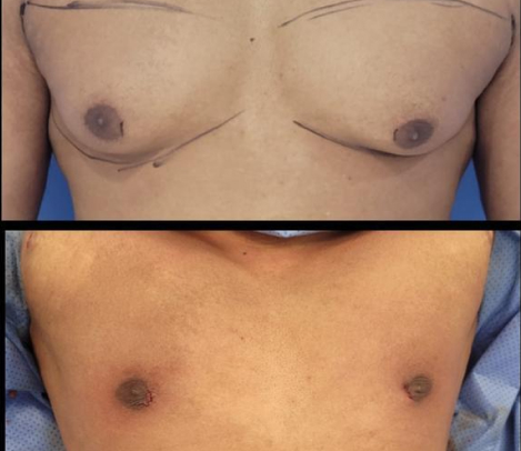 Top image shows a chest with markings for surgery; bottom image shows the same chest post-surgery, with flatter contour and healing incisions.