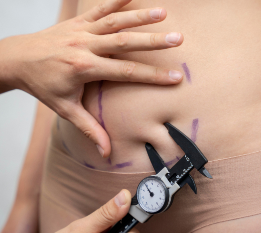 A person pinches their abdomen while another hand measures with calipers. There are purple markings on the skin. The person is wearing beige clothing.